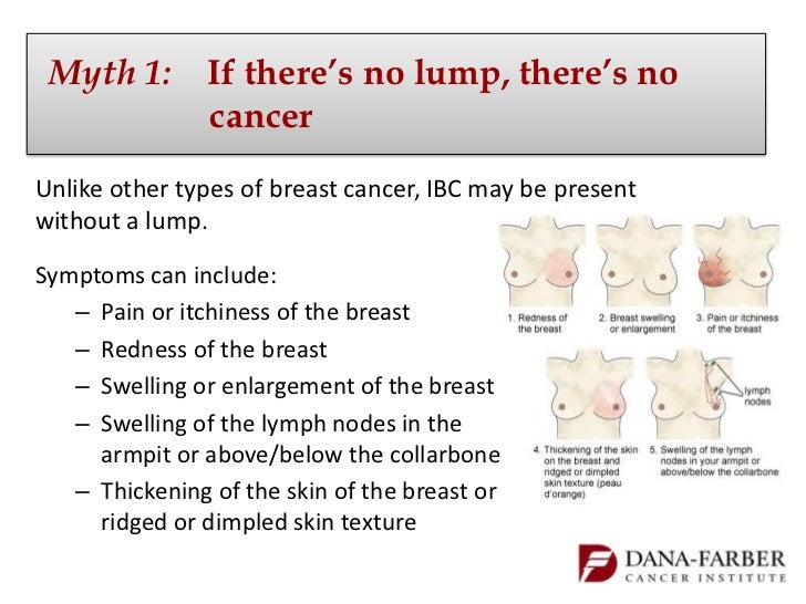 breast abscess vs. ibc Breast abscess vs. ibc